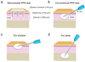 Image: Comparison of a microneedle tuberculosis test with a traditional test administered with a hypodermic needle. The lower images show needle-depth problems that can occur with the conventional test (Photo courtesy of the University of Washington).